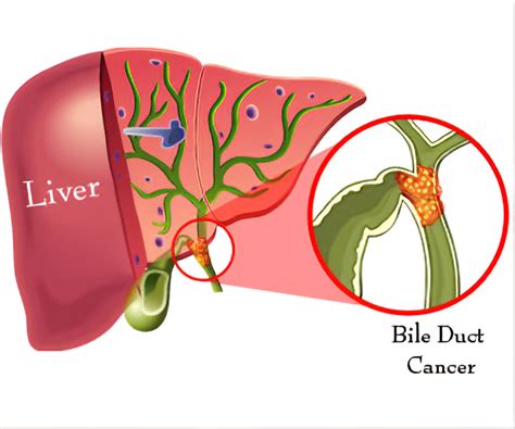 bile leakage symptoms|Problems after cancer surgery to remove part of your liver